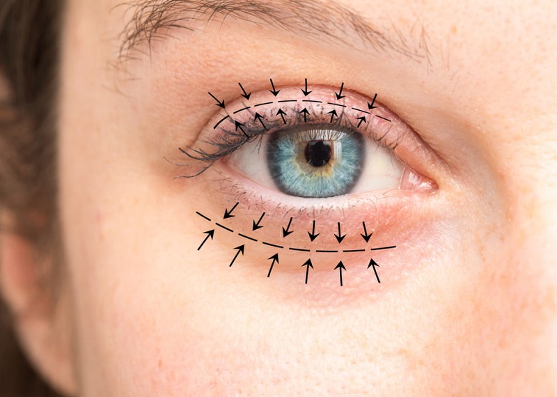 Cirurgia de Blefaroplastia Niterói