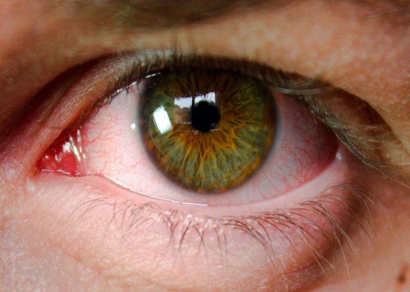 Cirurgia de Glaucoma Niterói