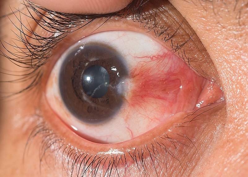 Cirurgia de Pterígio Niterói